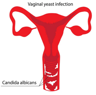 Вагинальный кандидоз — лечение травами